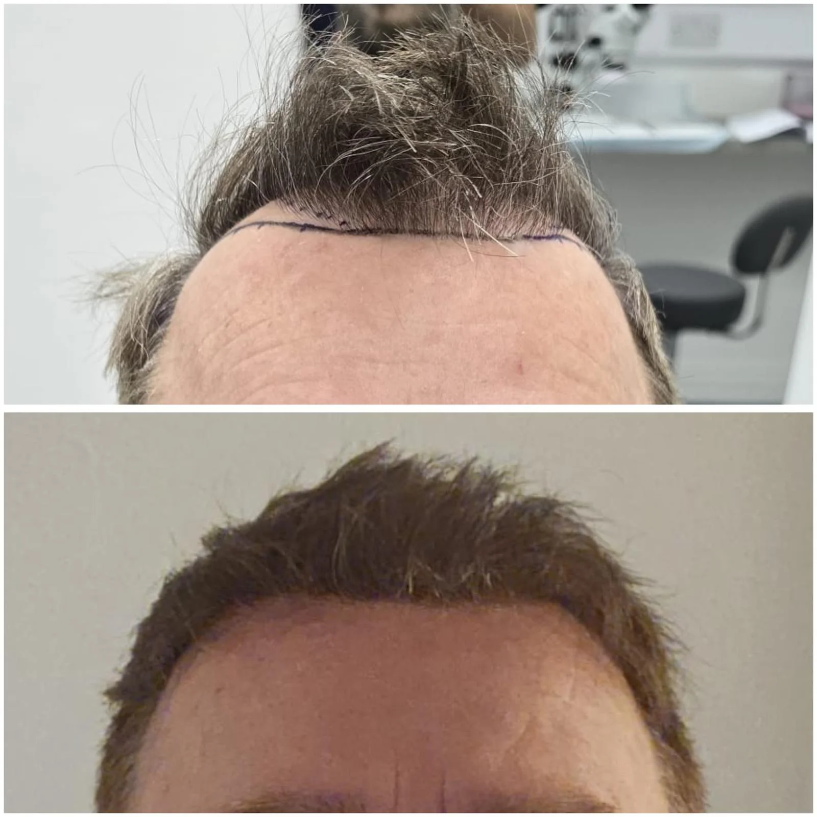 Hair transplant patient photo