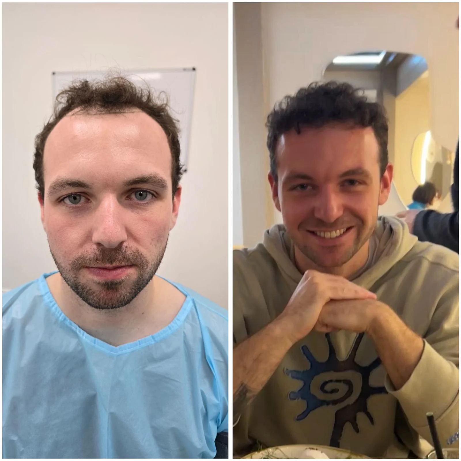 Hair transplant patient photo
