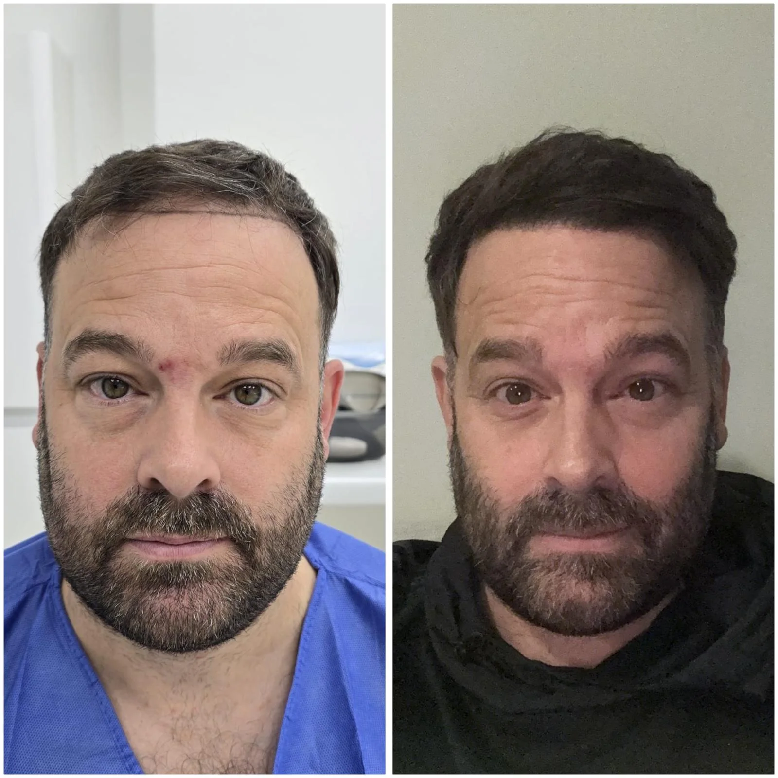 Hair transplant patient photo