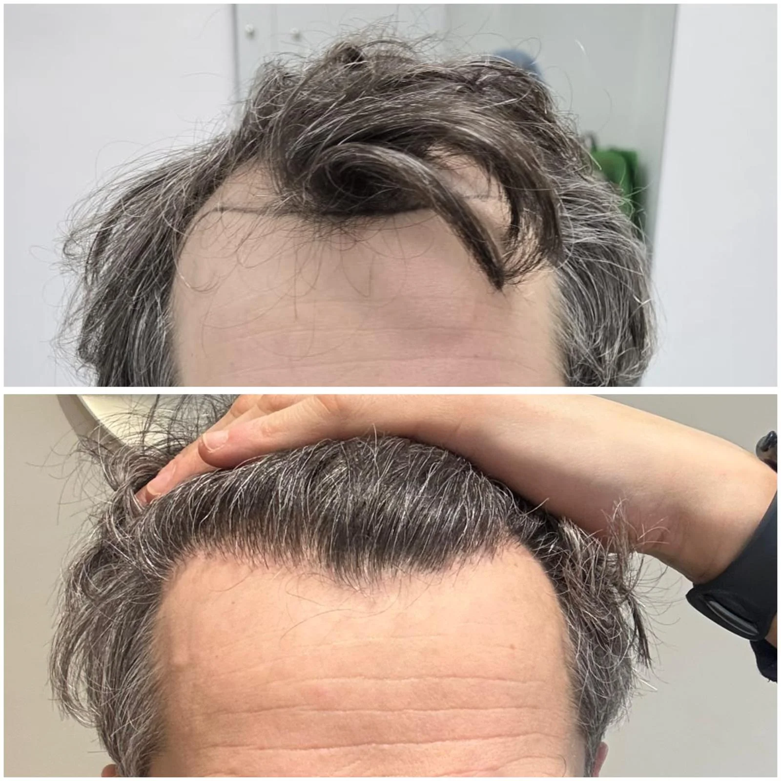Hair transplant patient photo