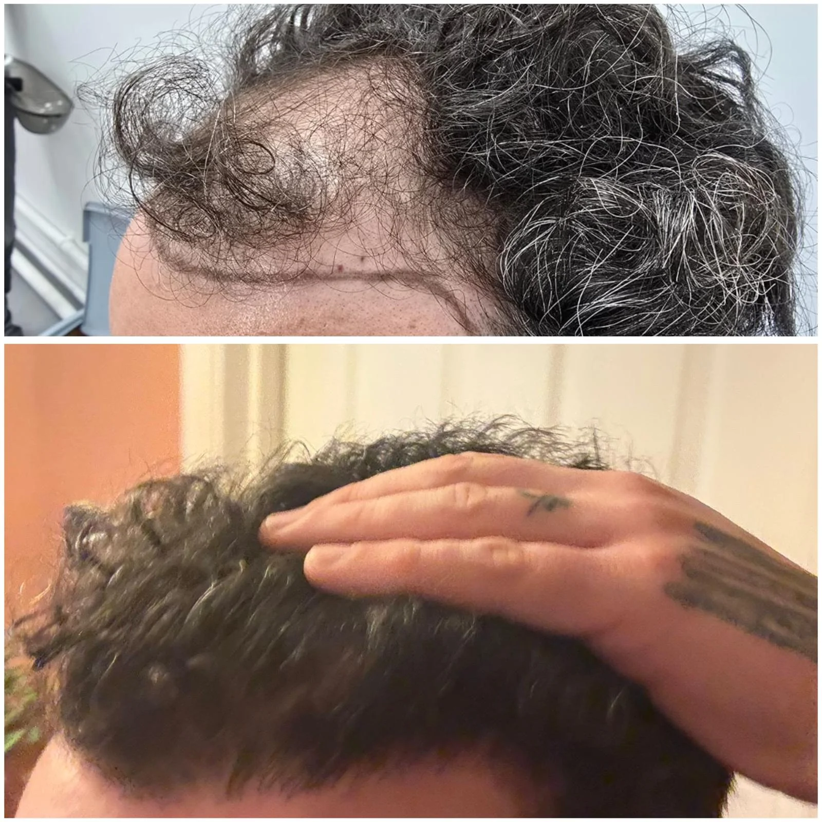 Hair transplant patient photo