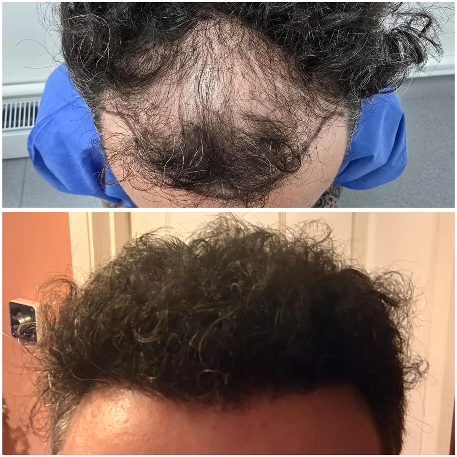 Hair transplant patient photo