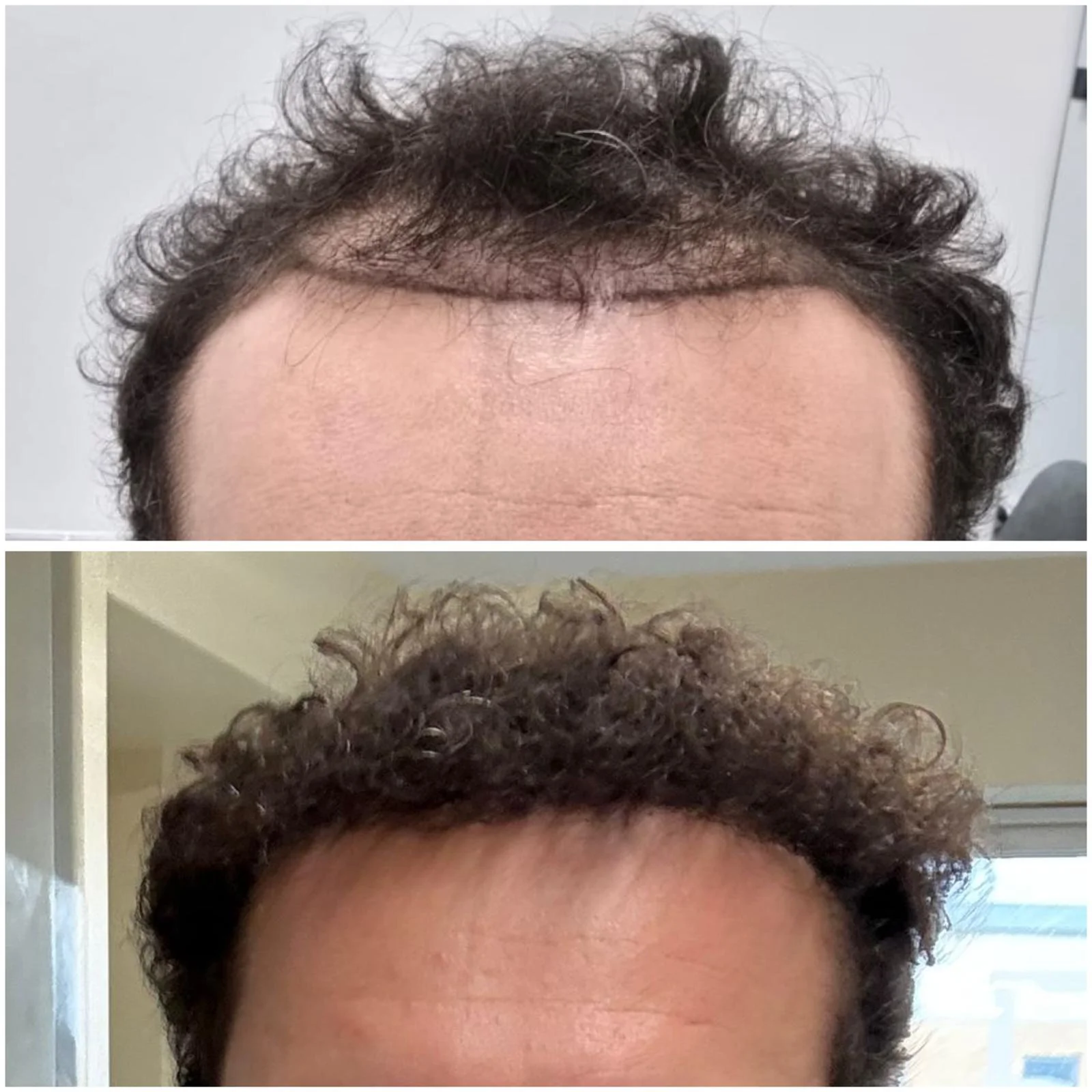 Hair transplant patient photo