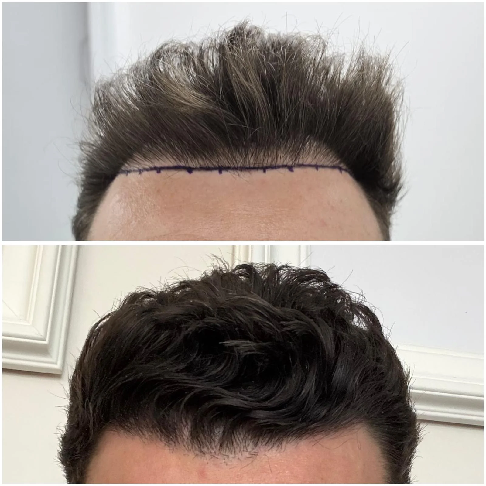 Hair transplant patient photo