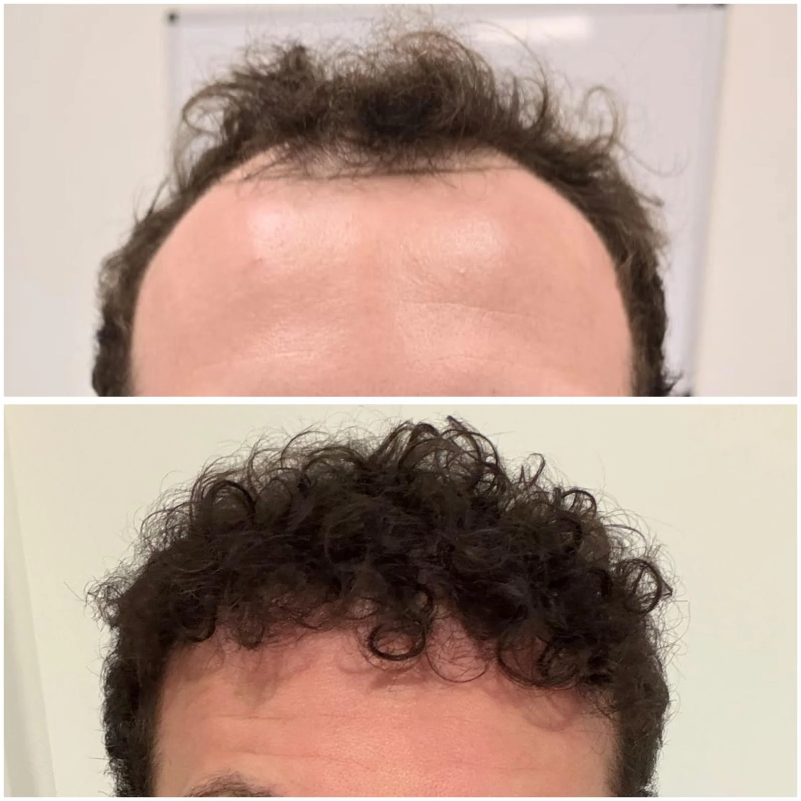 Hair transplant patient photo