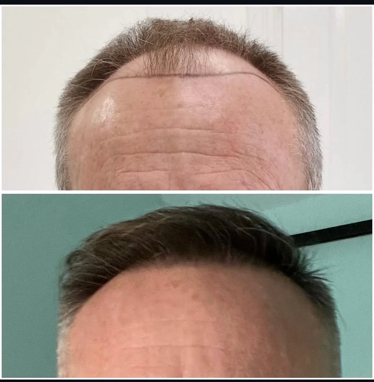 Hair transplant patient photo