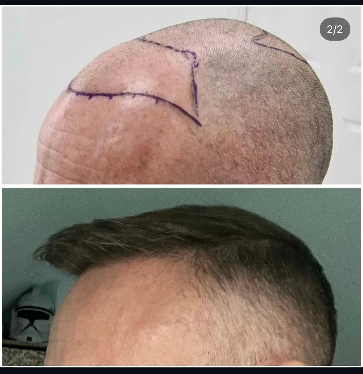 Hair transplant patient photo