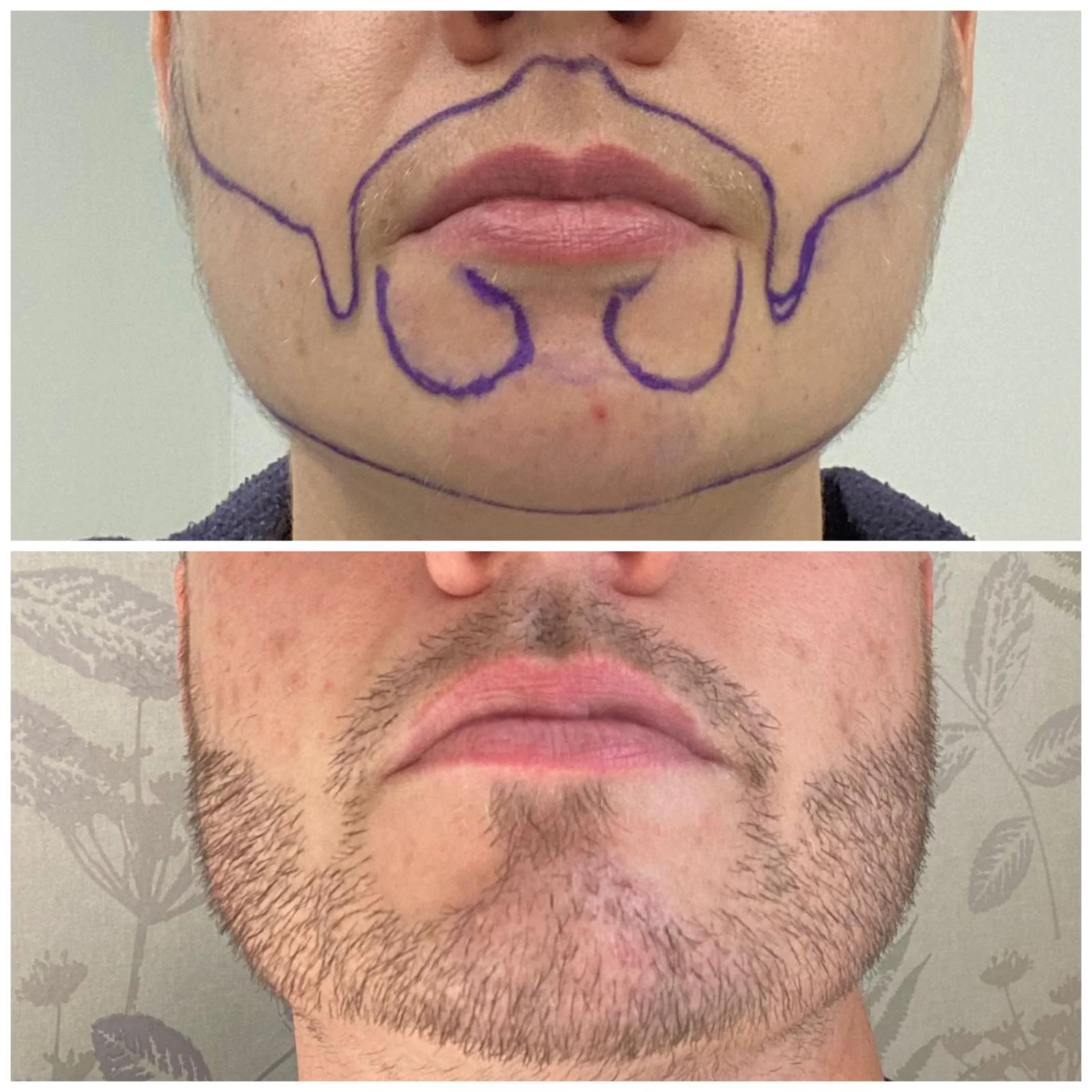 Hair transplant patient photo
