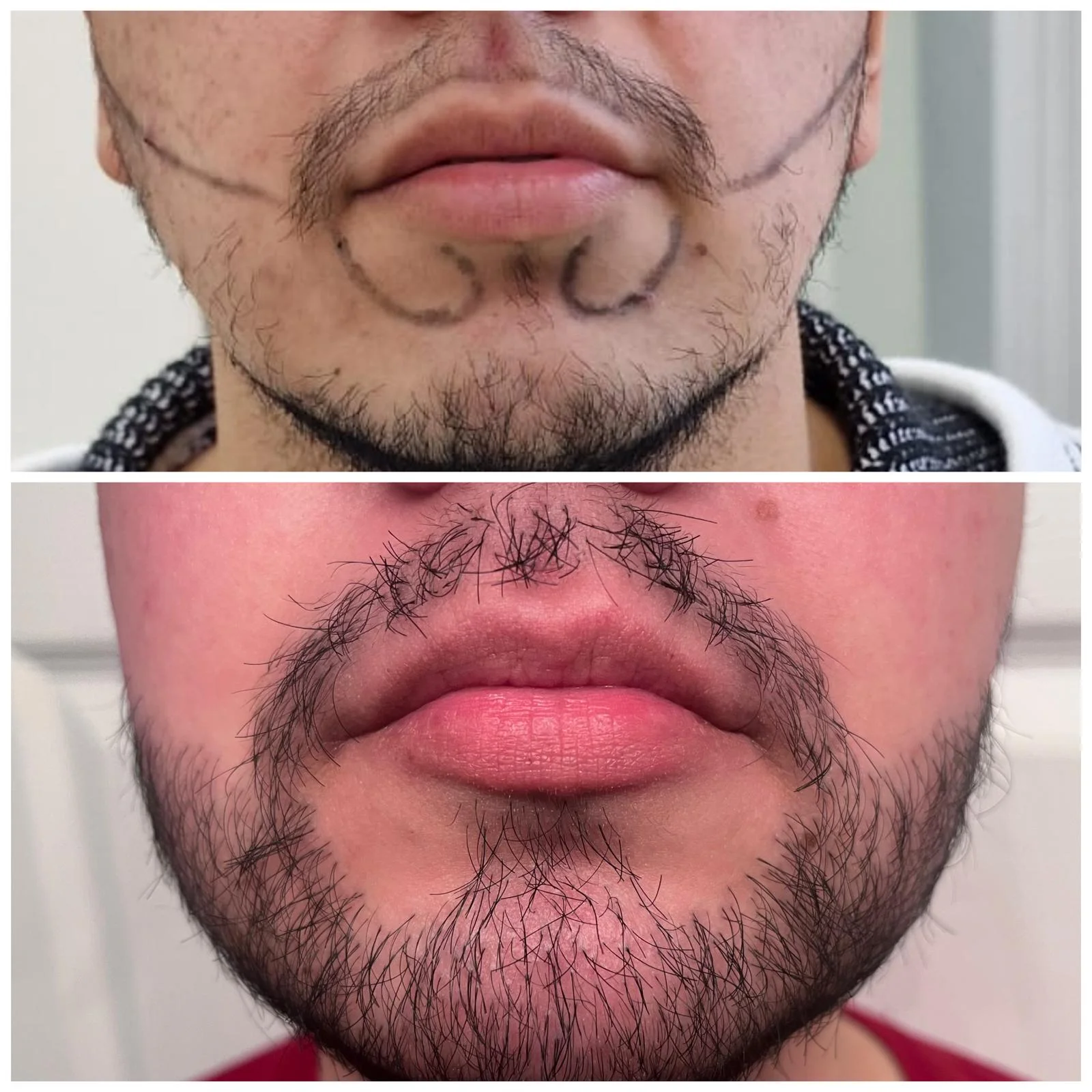 Hair transplant patient photo