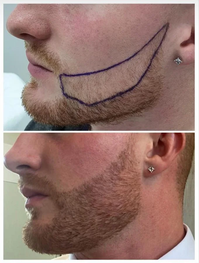 Hair transplant patient photo
