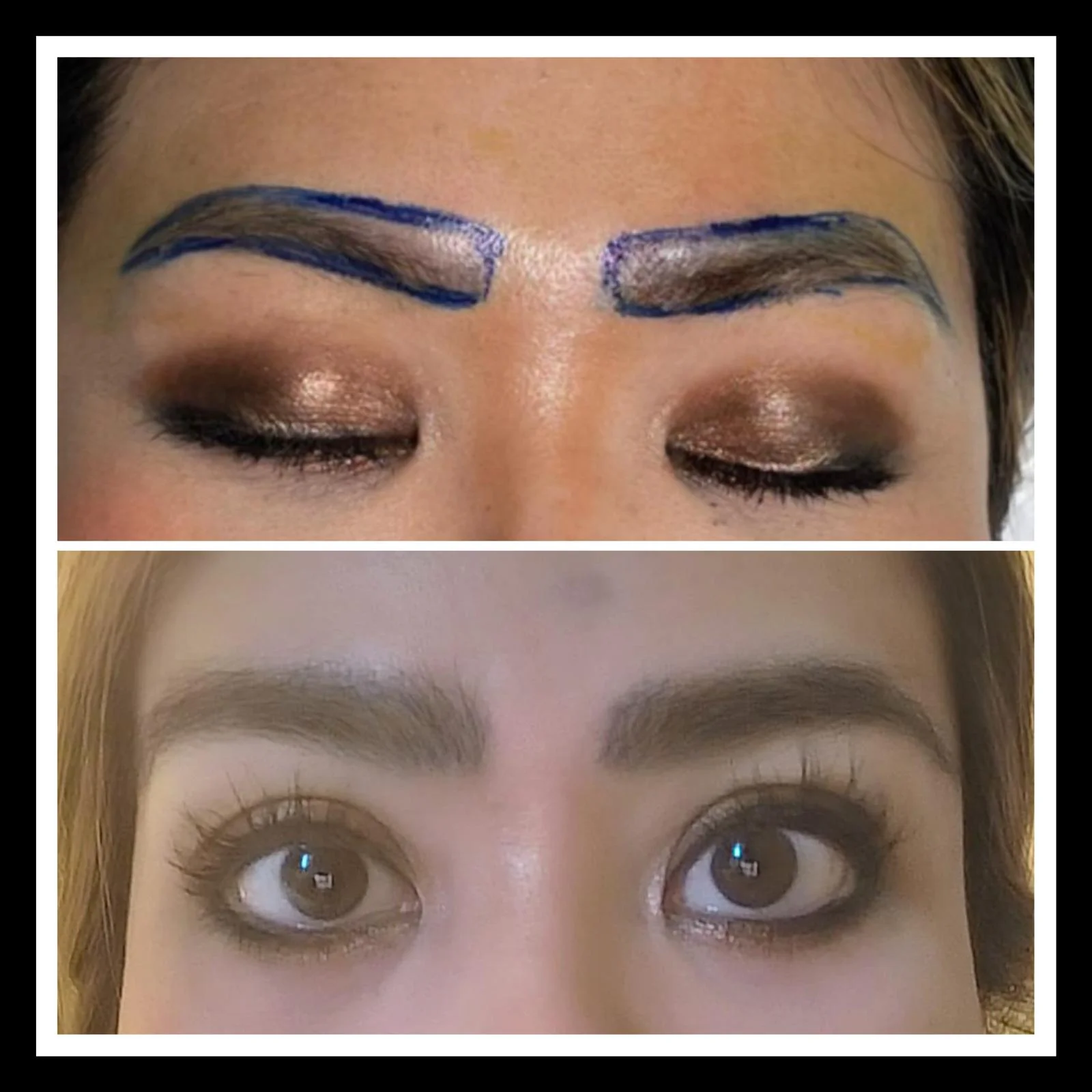 Hair transplant patient photo
