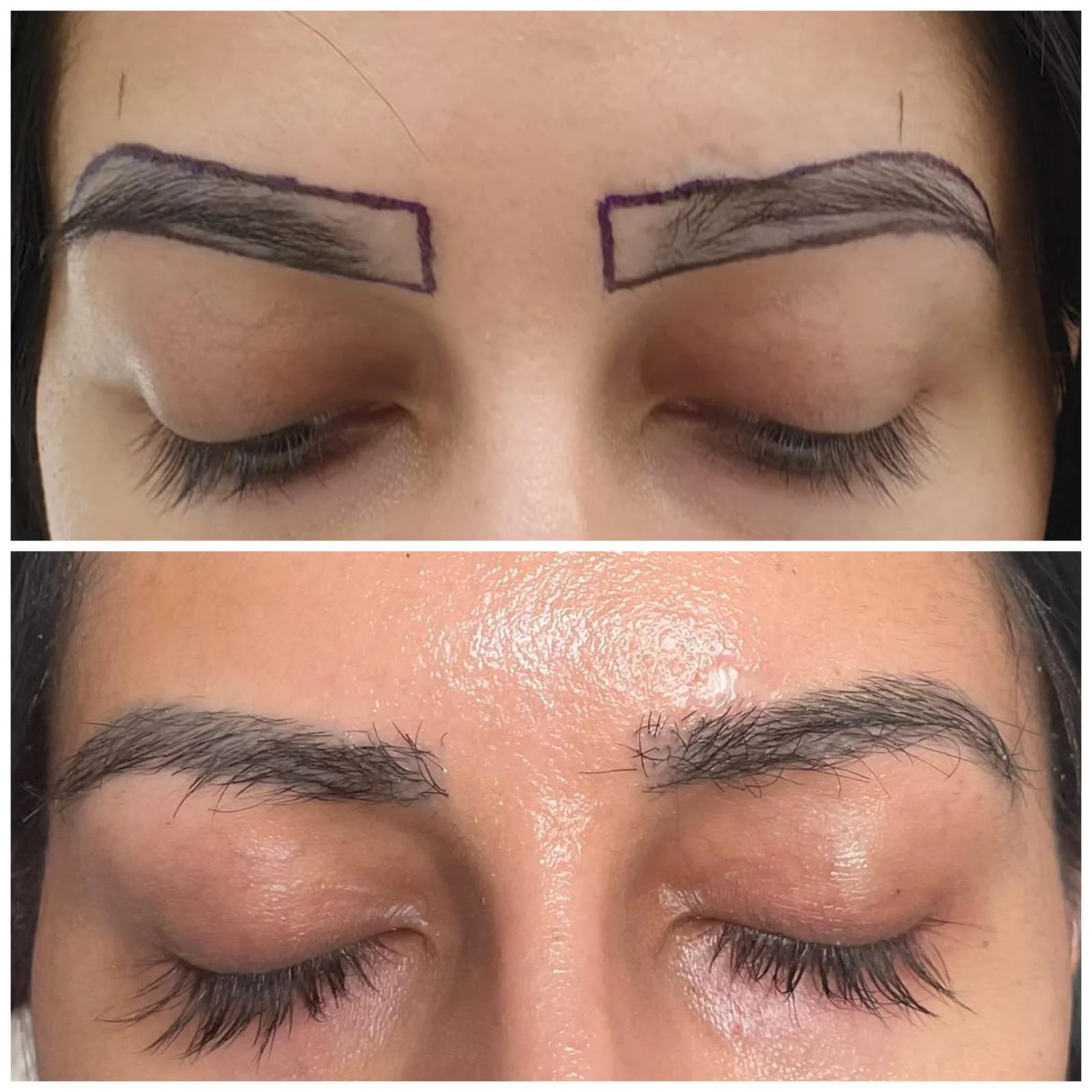 Hair transplant patient photo