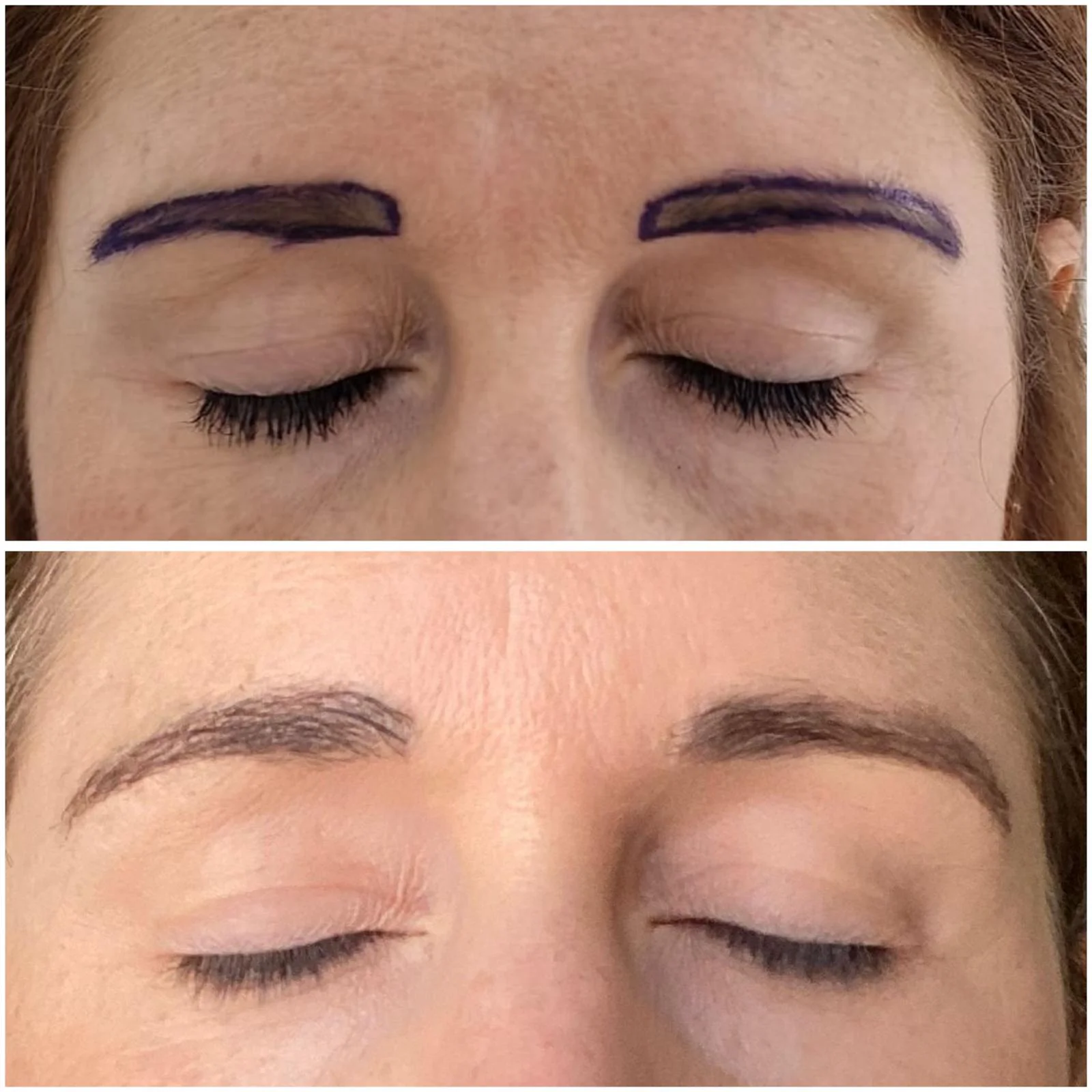 Hair transplant patient photo