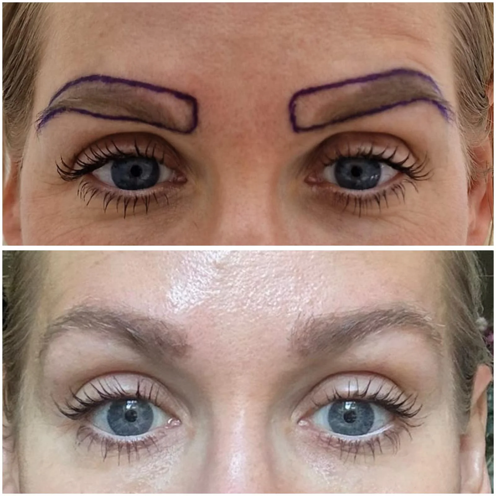 Hair transplant patient photo