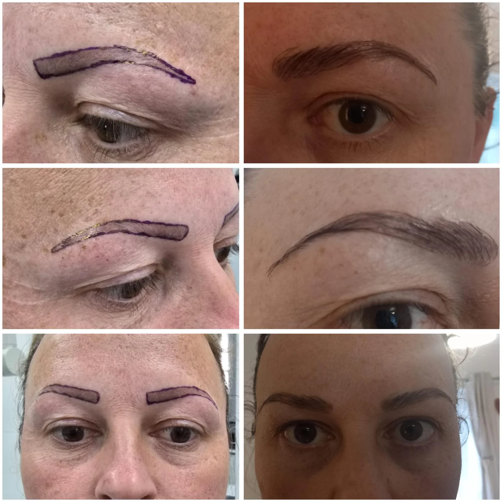 Hair transplant patient photo