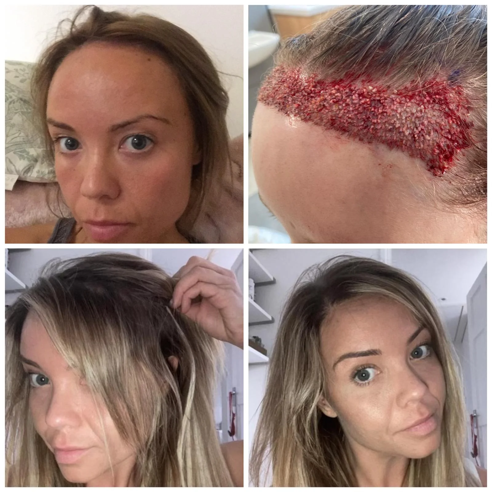 Hair transplant patient photo