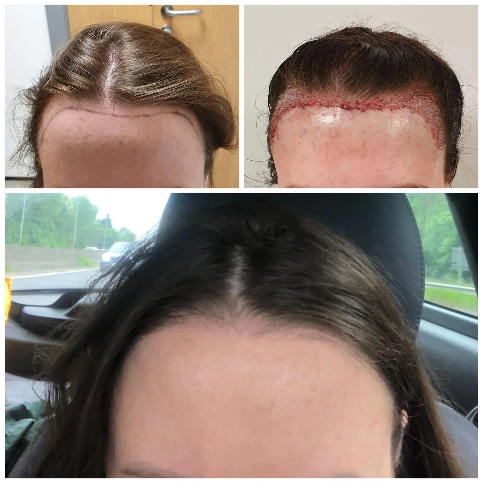 Hair transplant patient photo
