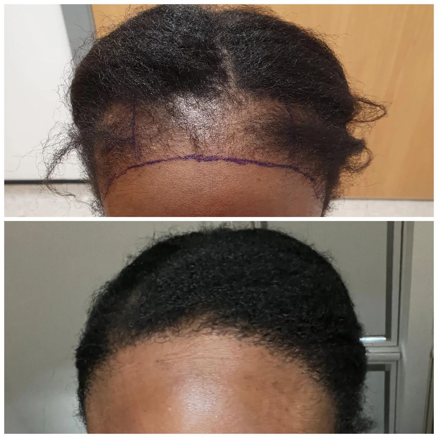 Hair transplant patient photo