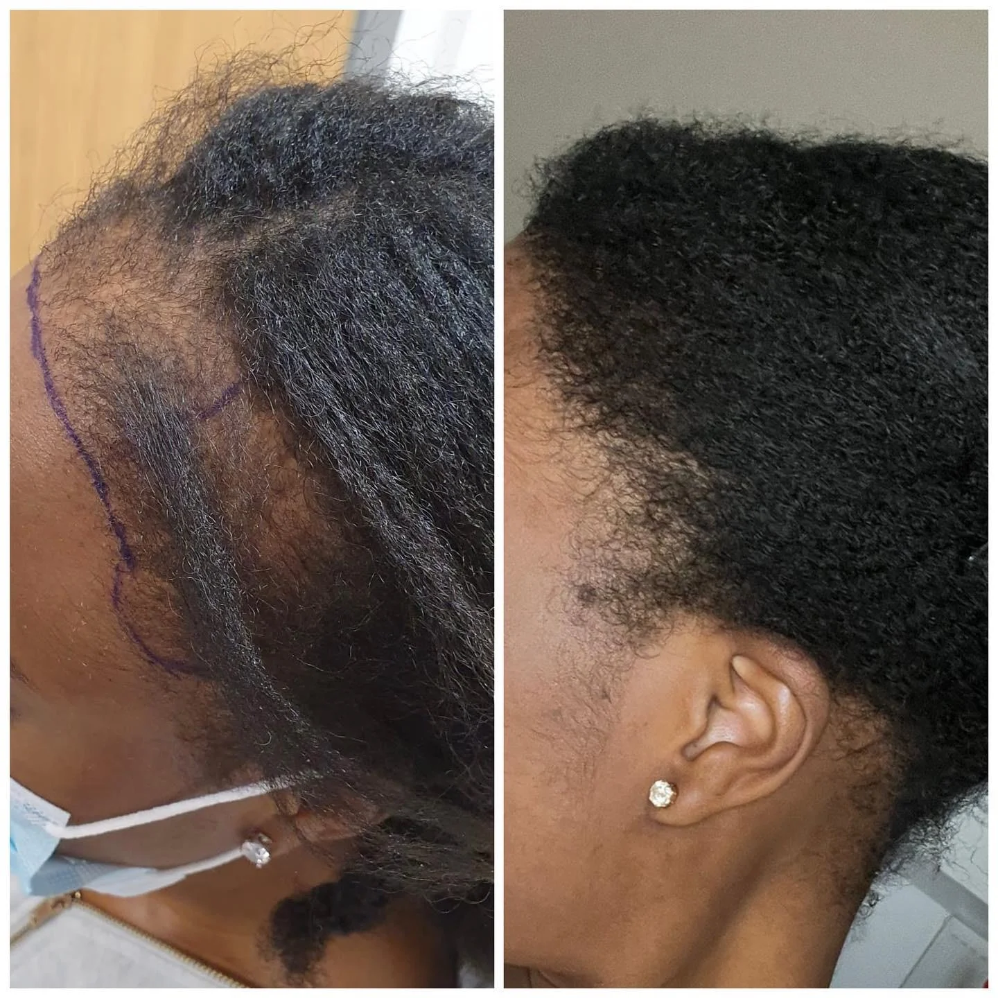 Hair transplant patient photo