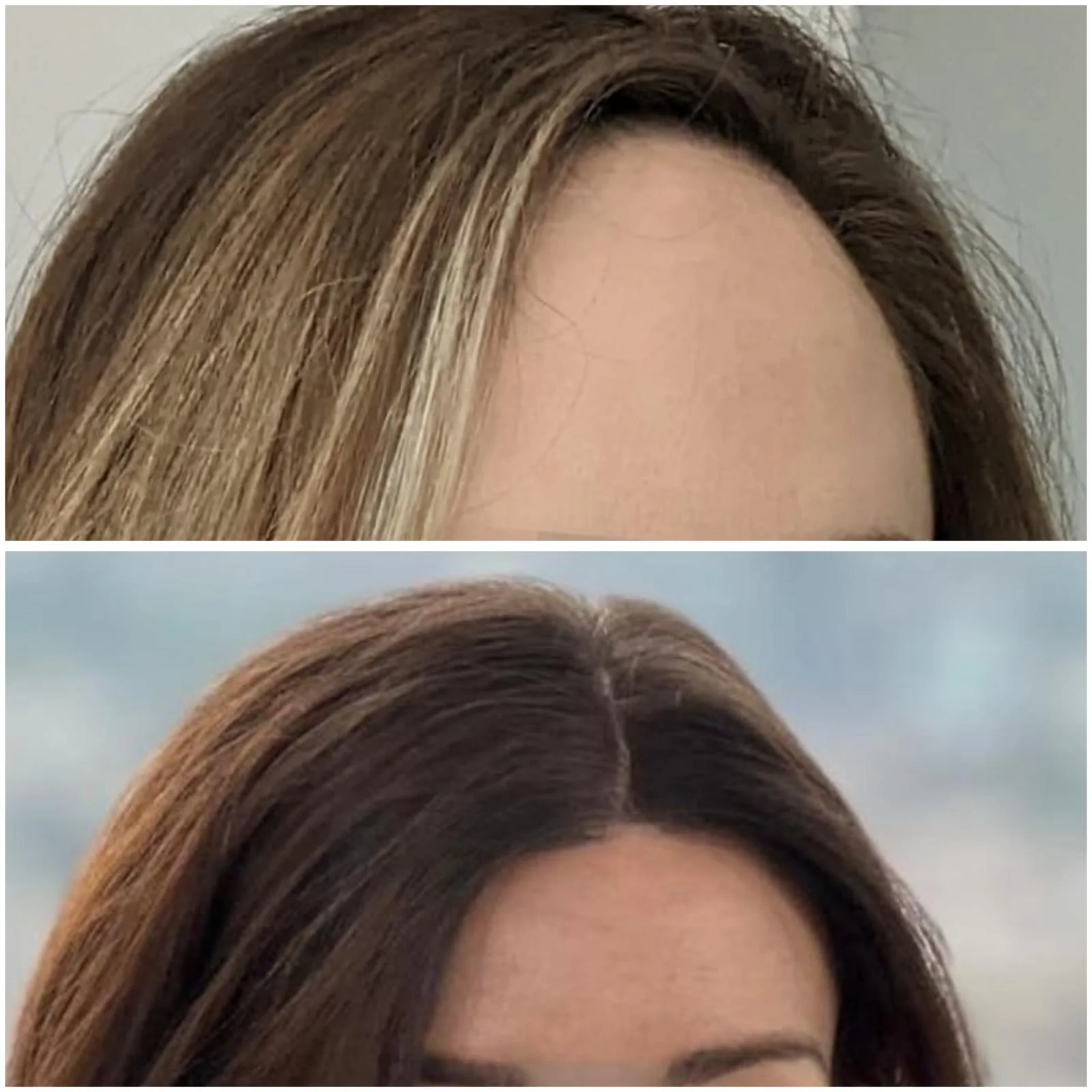 Hair transplant patient photo