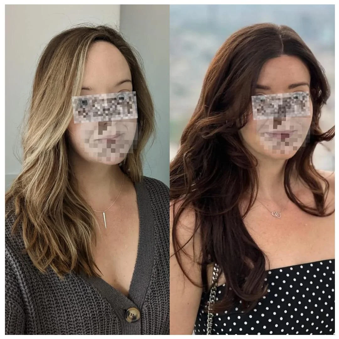 Hair transplant patient photo