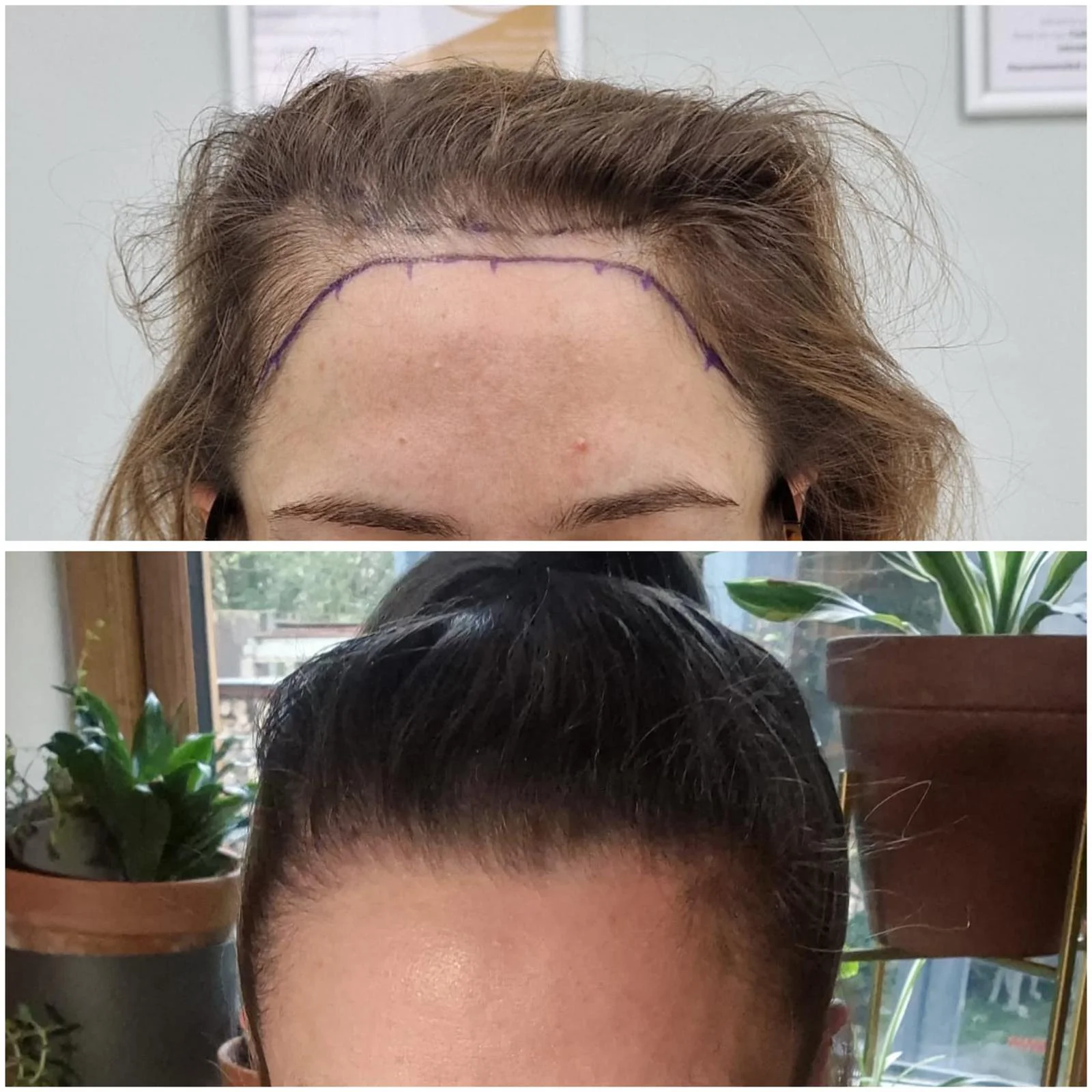 Hair transplant patient photo
