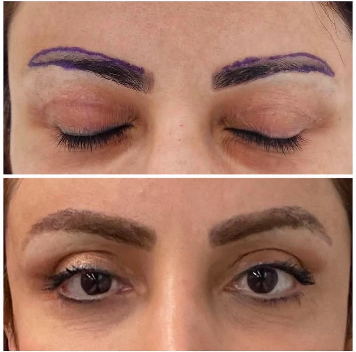 Hair transplant patient photo