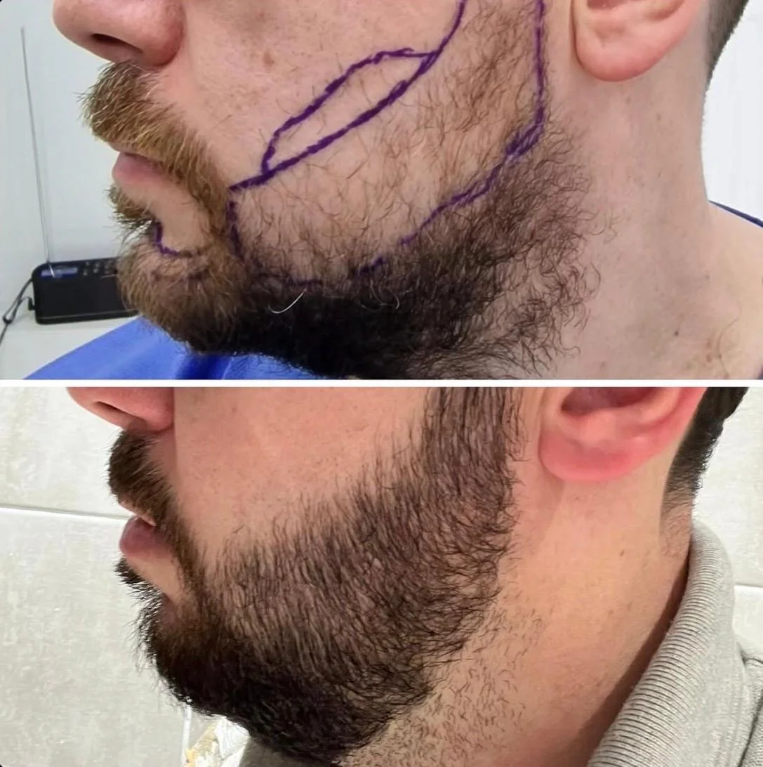 Hair transplant patient photo