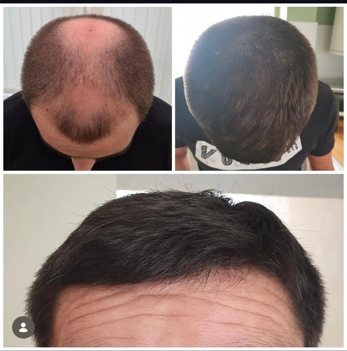 Hair transplant patient photo