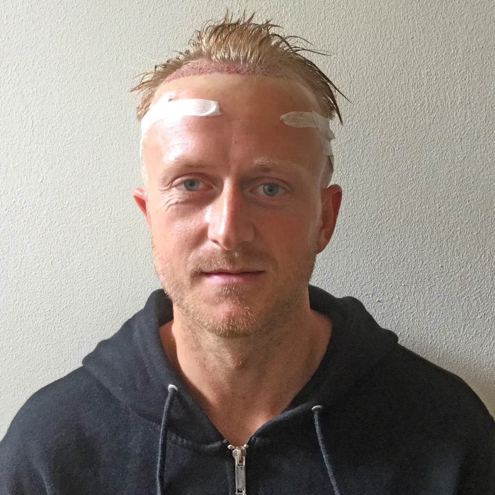 Ben immediately after his procedure