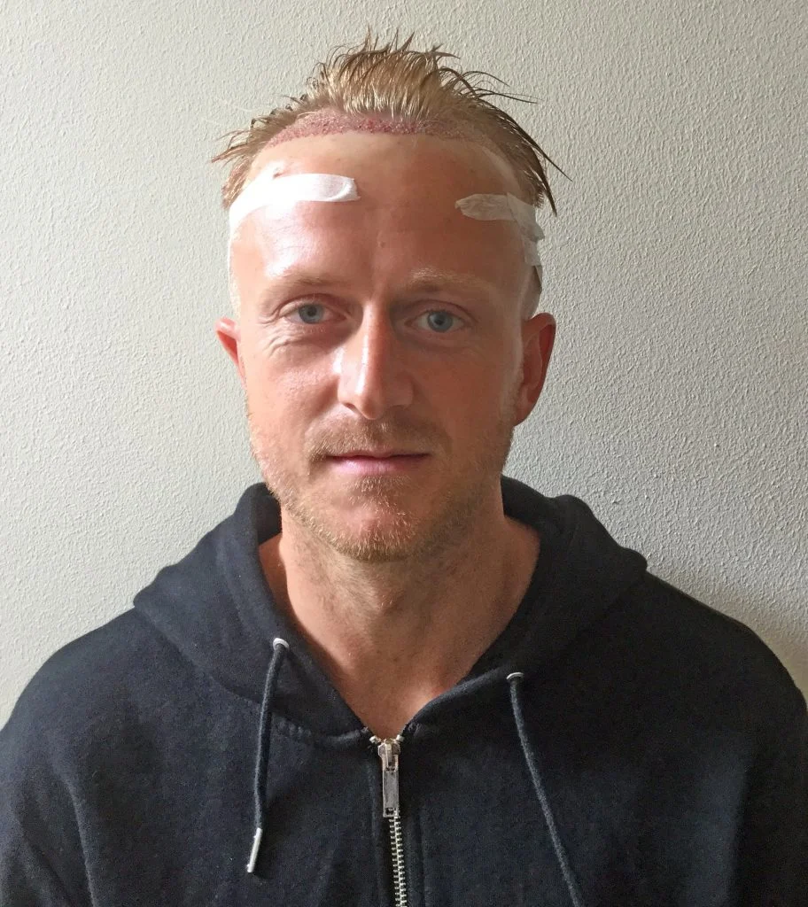 Ben Reeves after his hair transplant