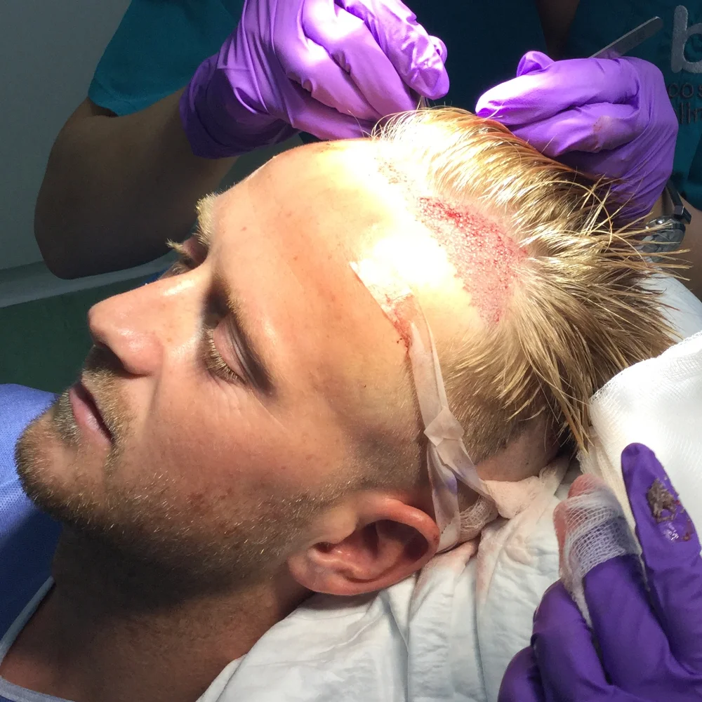 Implanting grafts under local anaesthetic