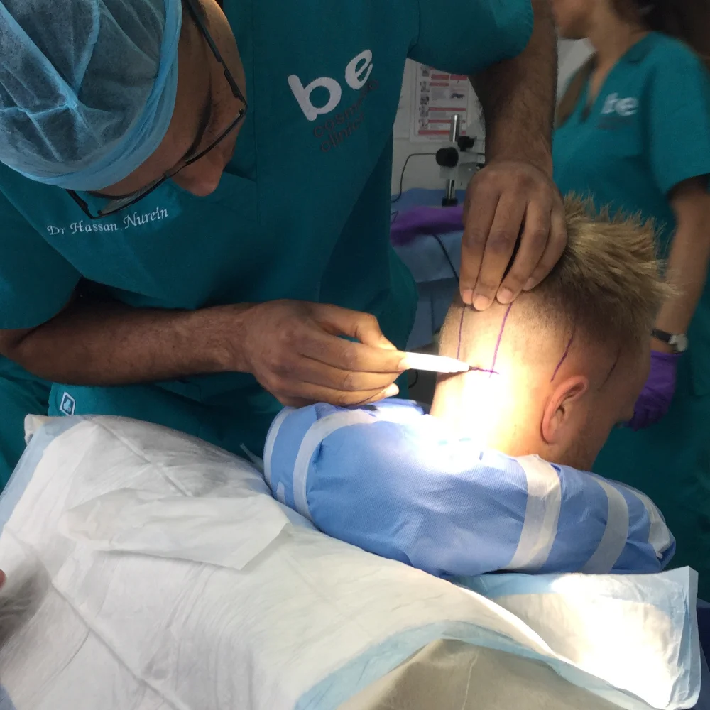 Close-up of the hairline mid-procedure