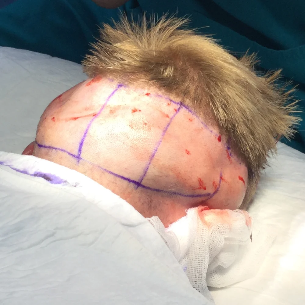 Ben on the day of his surgery — donor area marked