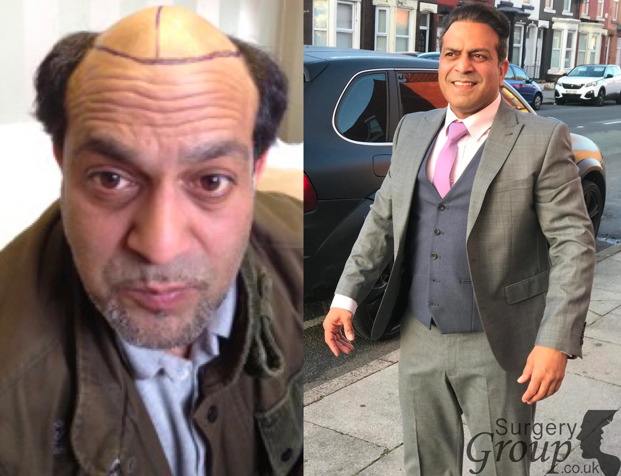 Chad before and after his hair transplant