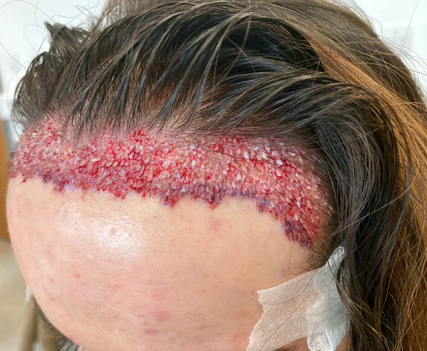 Georgia’s hairline result, side alternate angle