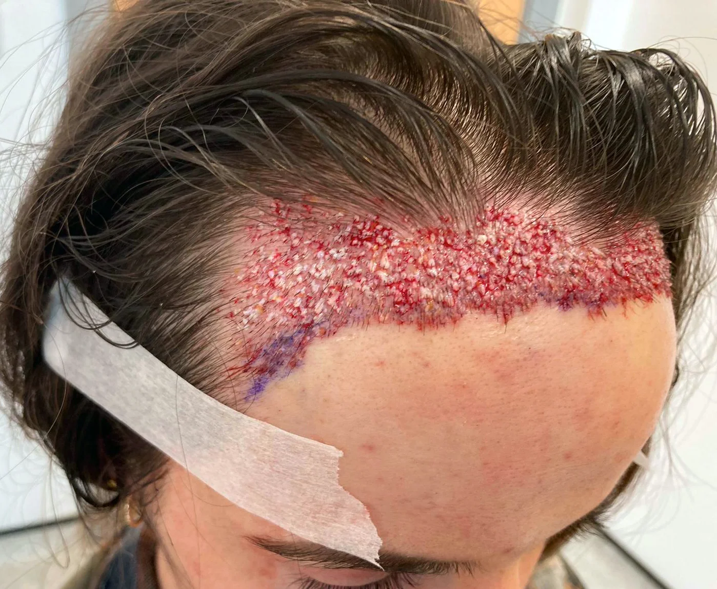 Georgia’s hairline after healing, side
