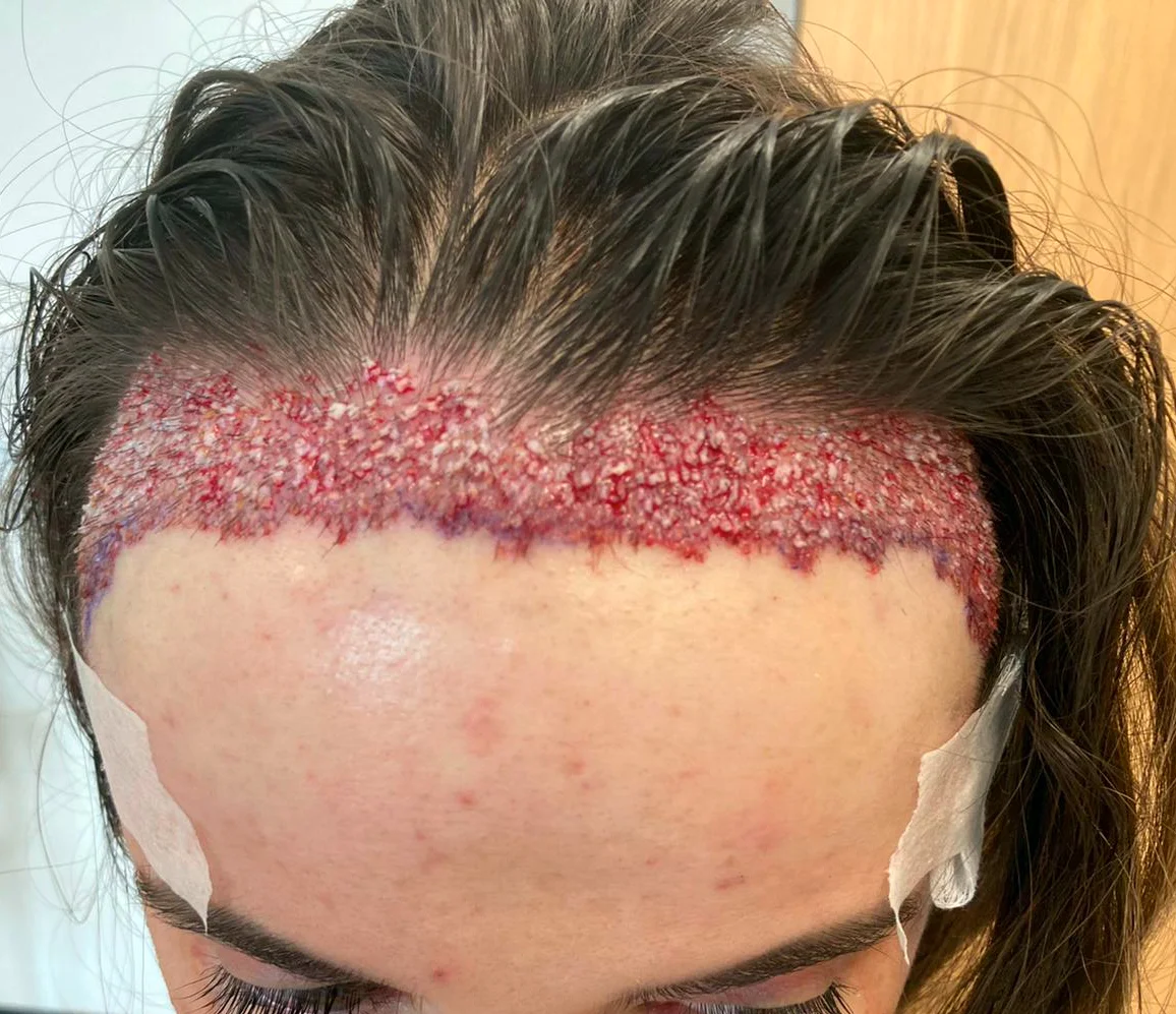 Georgia’s hairline after healing, front