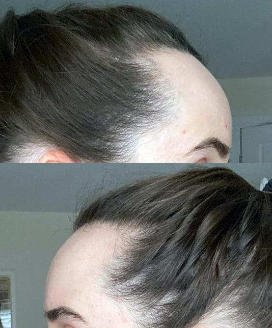 Georgia before the procedure, side profile