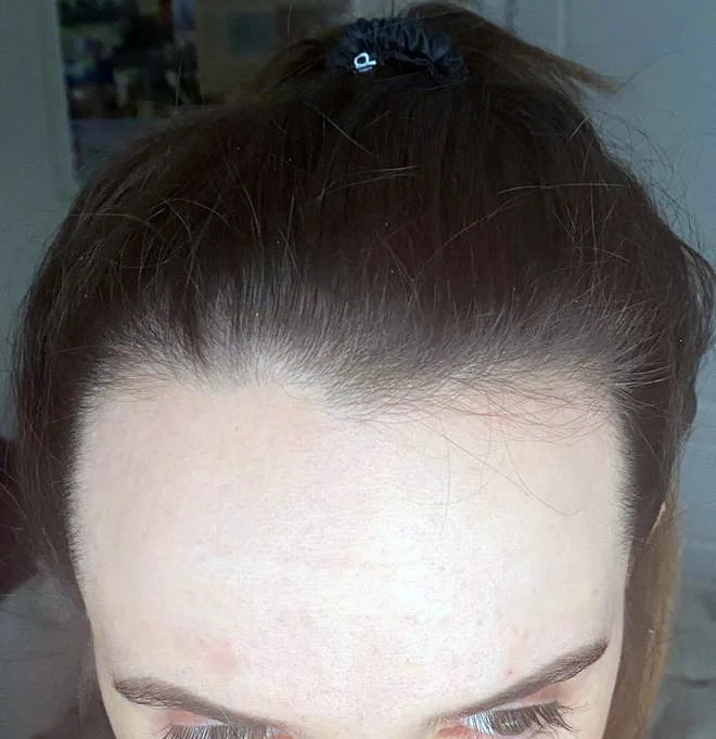 Georgia before the procedure, front