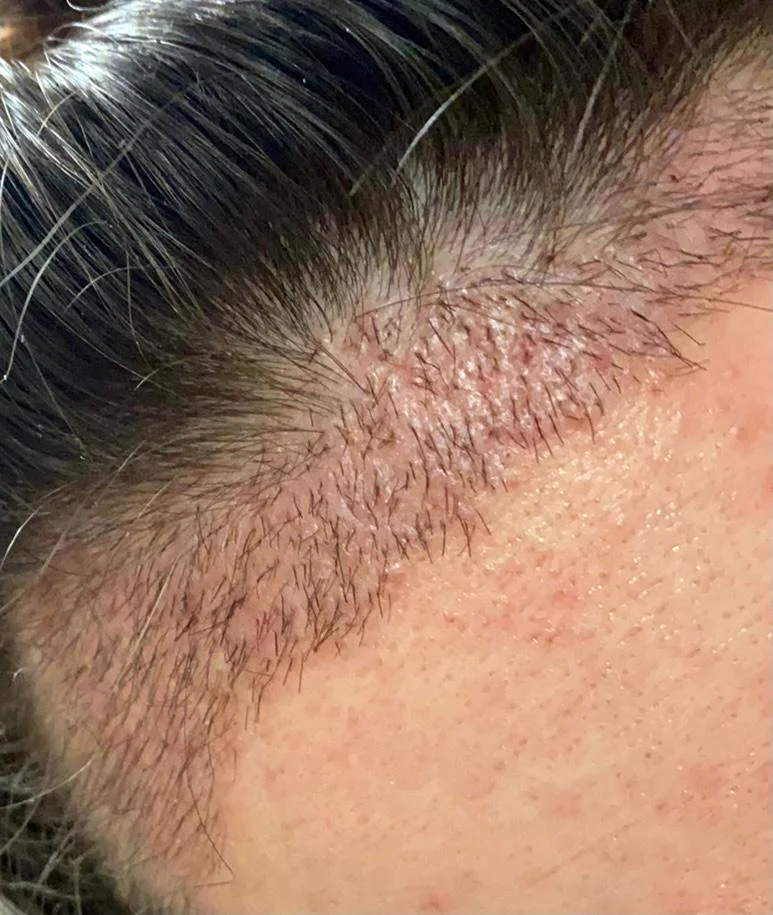 Georgia’s new hairline day 13