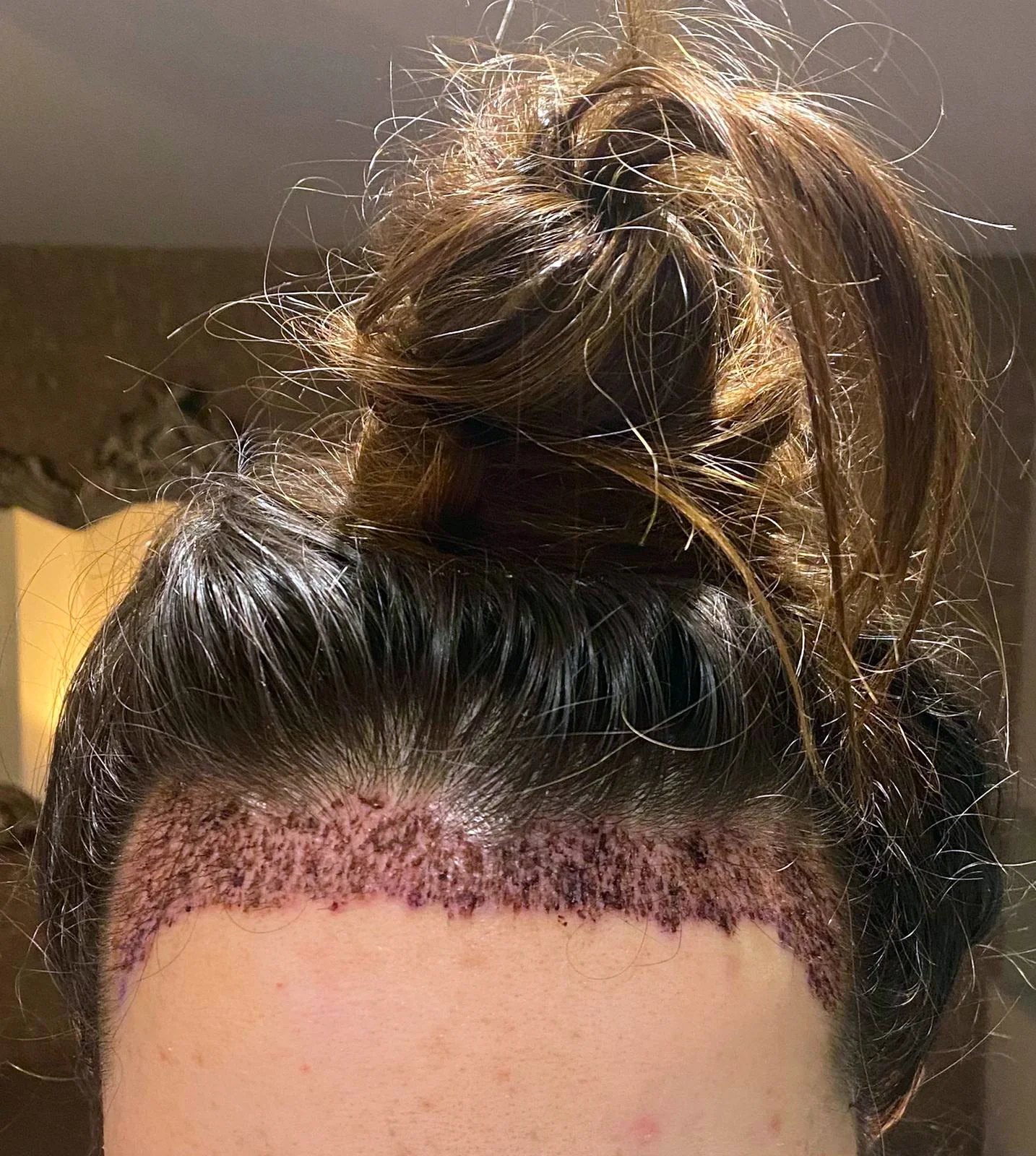 Georgia’s new hairline day 3