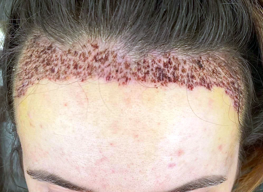 Georgia’s new hairline day 6