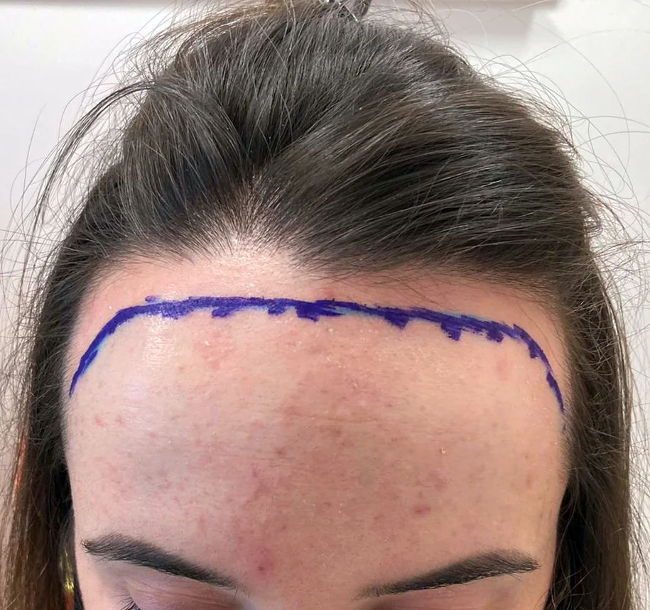 Pre-op hairline design drawn on Georgia’s scalp