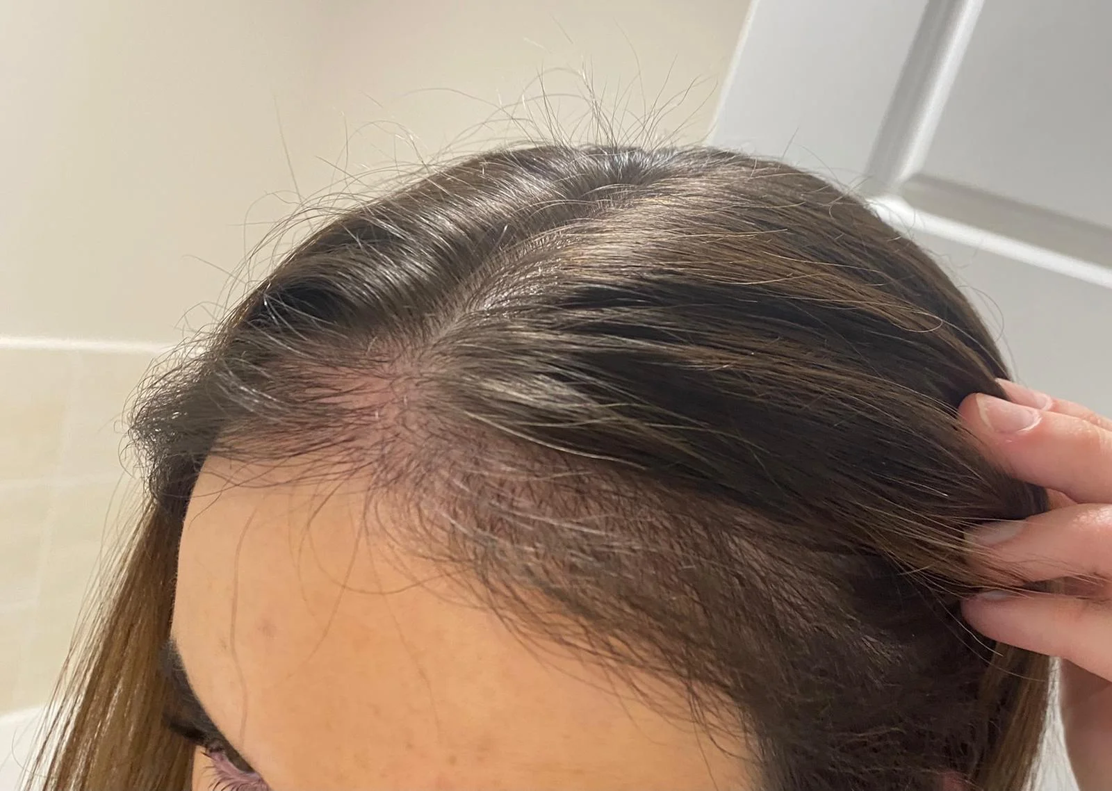 Georgia 7 months post-op
