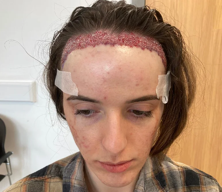 Georgia after her FUT hairline lowering