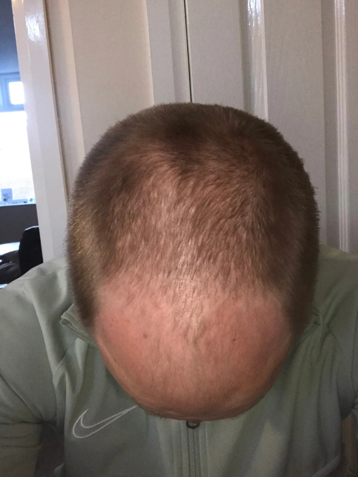 Jake before the procedure
