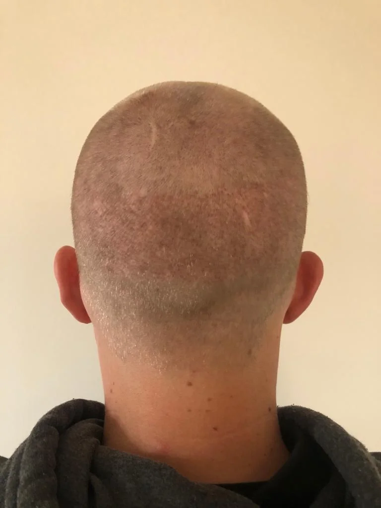 Jake’s donor area one month post-op