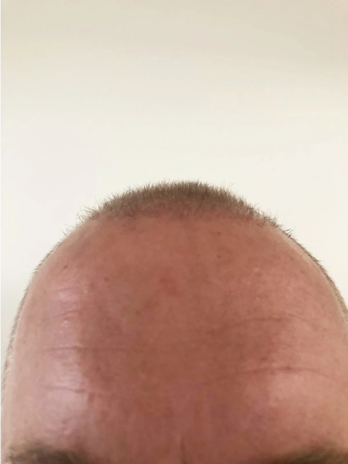 Jake 3 months post-transplant, second angle