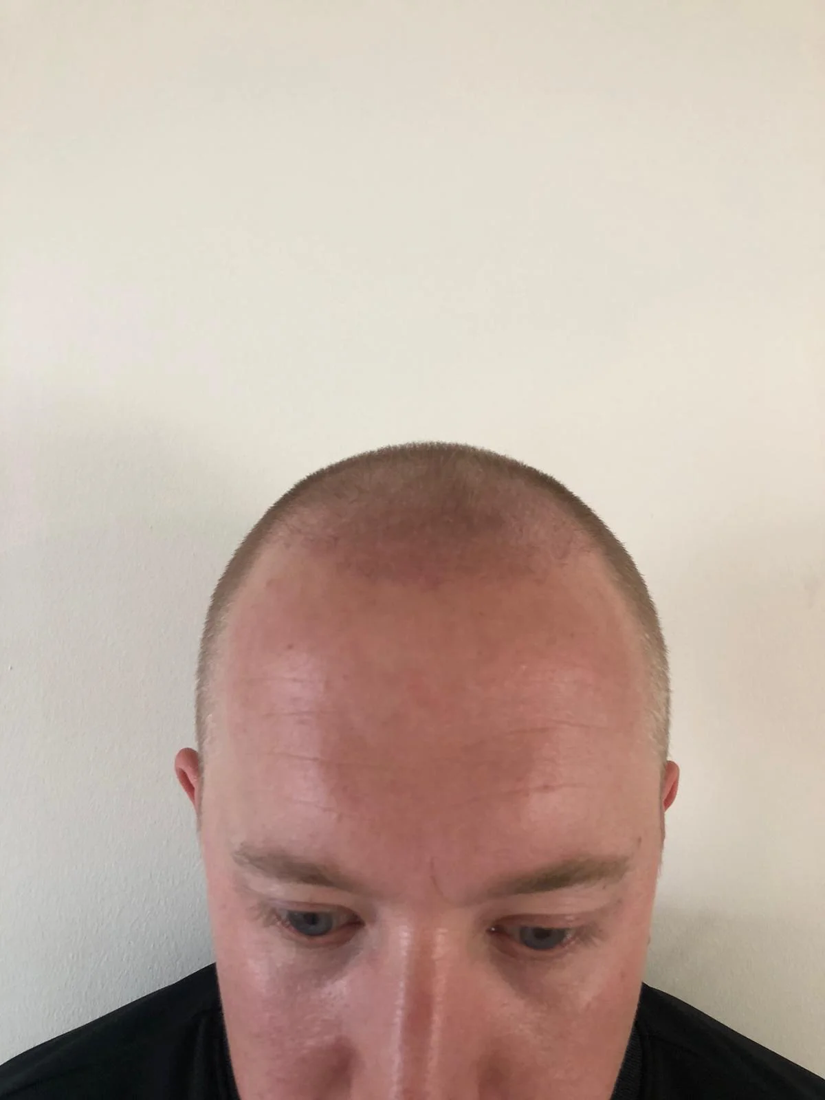 Jake 3 months post-transplant